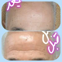 روغن بوتاکس