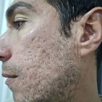 از بین بردن فوری جای جوش/لک/آکنه/اسکار/زخم و بخیه