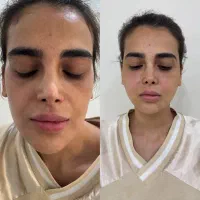 چربی زیبایی زنان/غبغب/بوتاکس/ژل/لابیاپلاستی