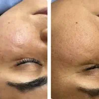 50درصد تخفیف کربوکسی تراپی و فیشال