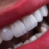 کامپوزیت و خدمات درمانی دندان