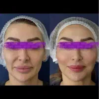 جشنواره ویژه هایفوصورت با دستگاه ۱۰ بعدی امریکایی