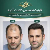 کلینیک تخصصی کاشت مو اتیه یزد با مجوز رسمی(VIP)