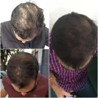 قطع ریش مو، ریش تونیک اکسونیک ، هرفرند مورینگا