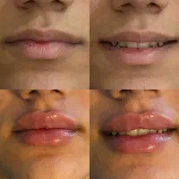تزریق ژل فیلر بوتاکس چربی و نخ لیفت با قیمت ویژه