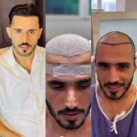 کاشت مو اقساطی به همراه یک جلسه PRPرایگان