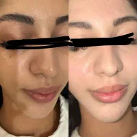 مزووایت(پوست روشن و سالم)مزونیدلینگ( درمان جوش)