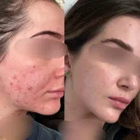 کرم ضد لک بیوممتیک جهانی با آف 50درصد تا آخر امشب