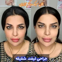 فیلر بادی، جراحی سرپایی زیبایی حجم دهی صورت بدن|خدمات آرایشگری و زیبایی|مرودشت, رودبال|دیوار