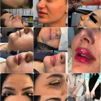 خدمات زیبایی«ژل و بوتاکس» با ۵۰ درصد آف