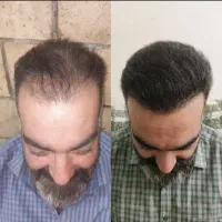 کاشت مو