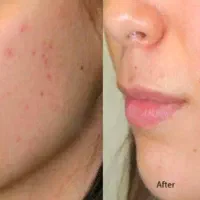 تزریق کرم پودر دایم فیشیال خال برداری
