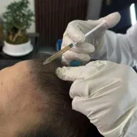 مزوتراپی و PRP ، هیرفیلر / مو و ابرو
