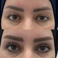 جراحی بلفاروپلاستی چشم با قیمت باور نکردنی