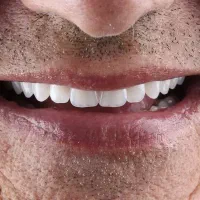 دندانسازی (تحویل فوری 1روزه) نقد و اقساط