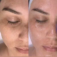 پاکسازی پوست صورت و سر و هایفوتراپی جوانسازی