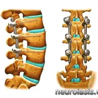 فروش ایمپلنت های کمری ( جراحی دیسک و تنگی کانال)