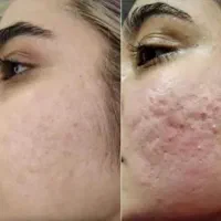 با روش جدید پوستتو هلو کن