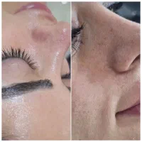 جشنواره ویژه فیشیال و پاکسازی پوست.