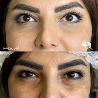 درمان ریزش مو و پر تراکم شدن مو