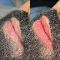 رفع درمانی و دائمی تیرگی لب