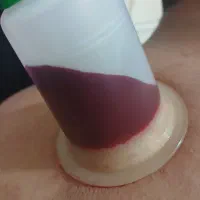 حجامت اسلامی بادکش گرم فصد سیاتیک دیسک