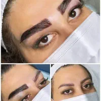 بلفاروپلاستی ۶۷۰۰ /غبغب ۶۷۰۰ /کاشت ابرو