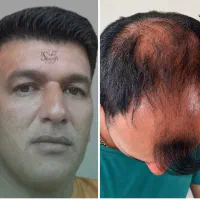 کاشت مو VIP شیرازی،بادستگاه جدید آلمان،سوزن ریز۰/۷