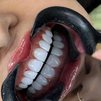 انجام کامپوزیت باهزینه استثنایی قبل ازافزایش قیمت