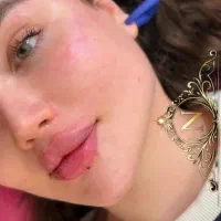 تزریق ژل و بوتاکس
