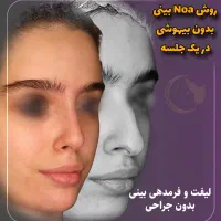 آف مکس لیفت صورت بینی شقیقه لب ابرو غبغب چشم زاویه