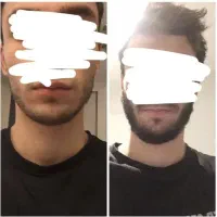 رویش صددرصدی ریش طی یک ماه
