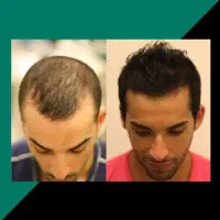۱۰۰ درصد قطع ریزش