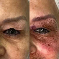 تزریق و آموزش فیلر و بوتاکس با ارائه مدرک