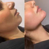 تخفیف ویژه تزریق ژل‌ و فیلر،بوتاکس،آنزیم ‌و پرسینگ