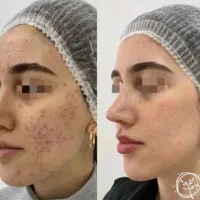 مدل فشیال تخصصی و میکرو نیدلینگ
