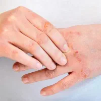 پیسی پسوریازیس اگزما ماکولار قارچ