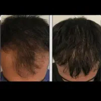 روش جدیدبرای درمان ریزش موورویش مجددموهای ریخته