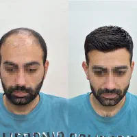 خدمات پروتز مو/تعویض چسب
