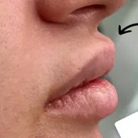 آنزیم هیالاز انگلیسی حذف فیلر و ژل
