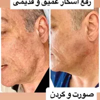 ار اف فرکشنال و روشن کننده کرربن معجزه پوست