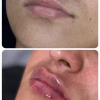 تزریق فیلر لب، فیلر لب نچرال،مطب پوست