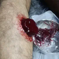 حجامت درمانی و ریکاوری و بادکش تخصصی