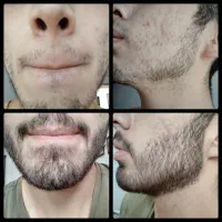 پرپــشتــی ریش سیبل