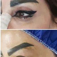 عمل جراحی پلک. بلفارو پلاستی.