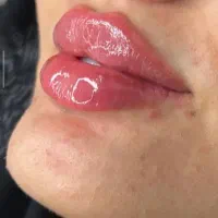 جشواره فول فیس پرسینگ چالگونه ژل گونه لب فیلر ژل