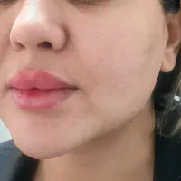 مدل تزریق فیلر لب ،گونه چونه زاویه