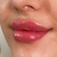 ژل لب کانتورصورت بوتاکس مزوژل جوانسازی آنزیم