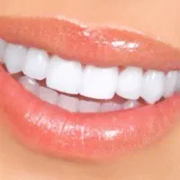 دست دندان طرح لمینیت