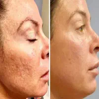 پی ار پی PRPسلول بنیادی جفت جنین،ترمیم زخم بوتاکس